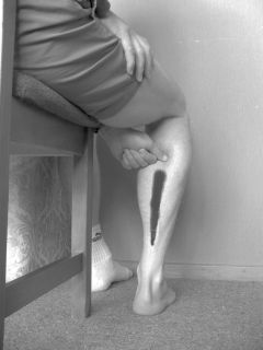 ptriggerpointcaudalbw