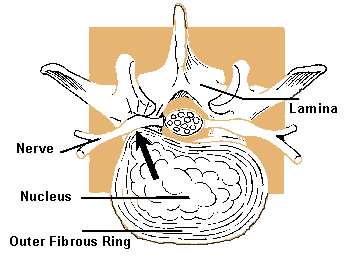 Lumbar Spine, Siatic Nerve Injury - Transverse View