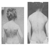 Scoliosis Straightened! - by exercises!