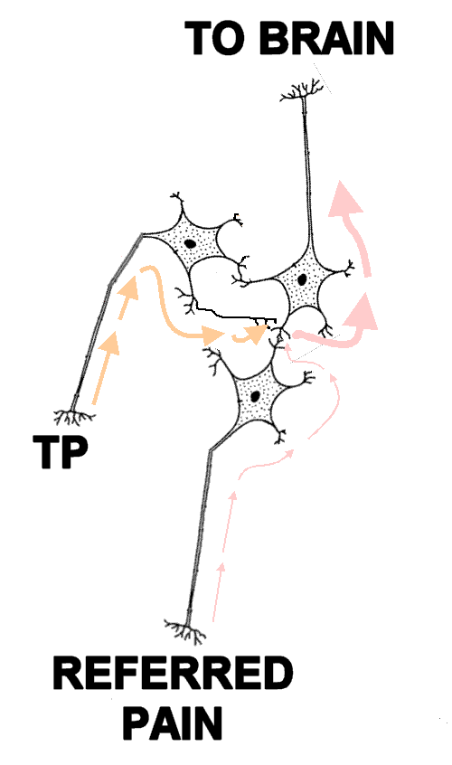 Trigger Point Pain Referral - Diagram of Convergence Facilitation